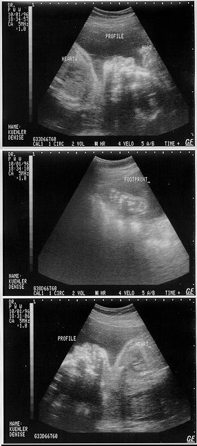 Sonogram from 10/1/96
