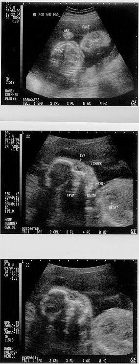 9/4/96 ultrasound